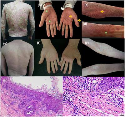 Case Report: Successful Treatment of Acute Generalized Exanthematous Pustulosis With Secukinumab